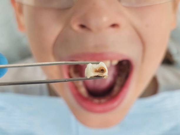 Best Emergency Treatment for Dental Infections or Abscesses in Liberty, NC